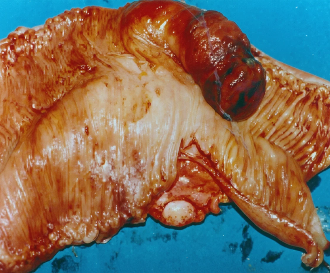 Small Bowel Vascular Tumor presenting with Intermittent Bleeding and Intussusception.