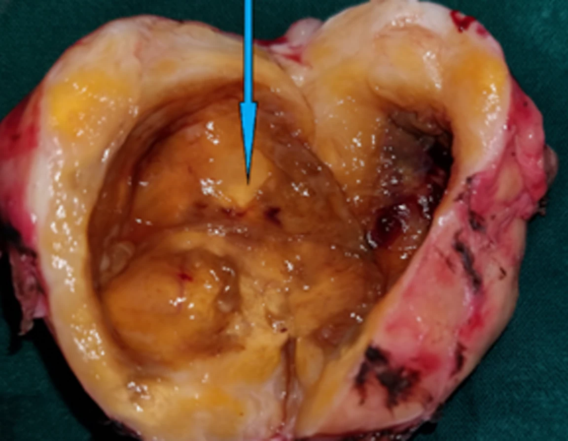 Presacral Cystic Schwannoma.