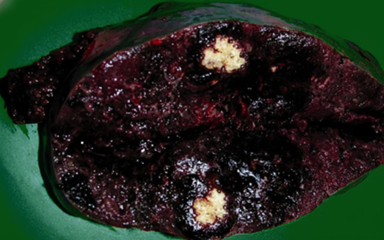 Figure 2.The enlarged spleen in cross-section.(Courtesy Dr.V.Penopoulos).