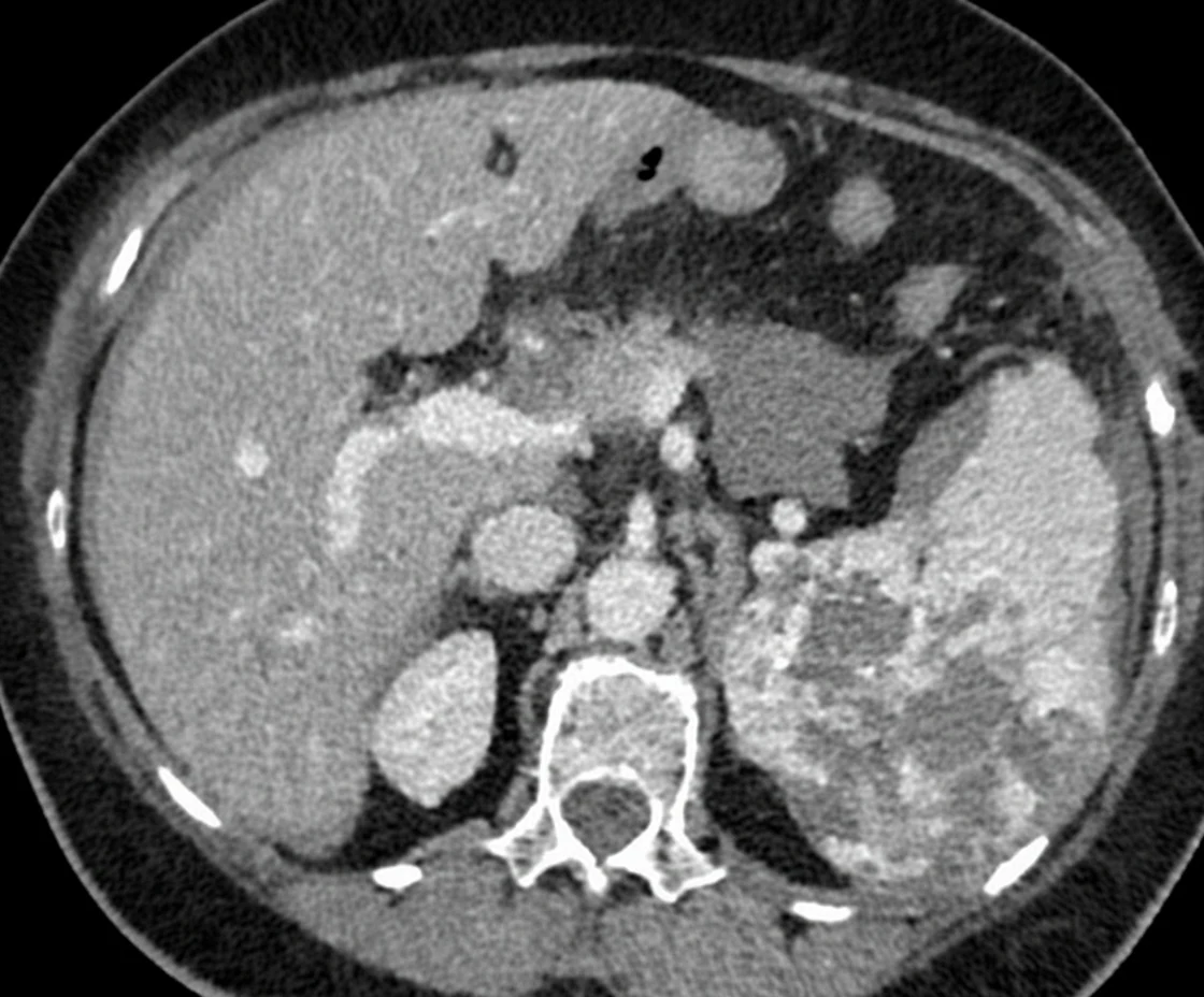 Figure 1.Abdominal CT Scan.Notable splenic enlargement with heterogeneous composition and presence of multiple low density lesions.(Courtesy Dr.V.Penopoulos).