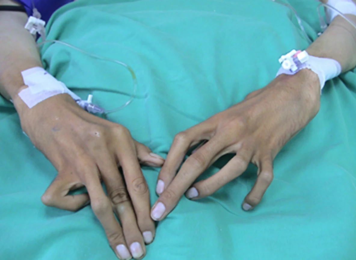 Marfan Syndrome and Acute Abdomen.