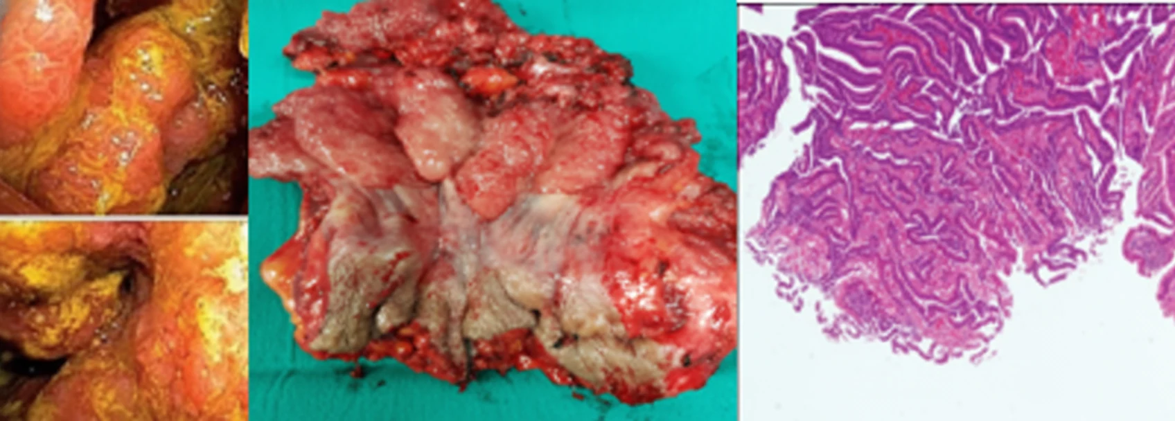 Giant Rectal Villous Adenoma Recurrence.