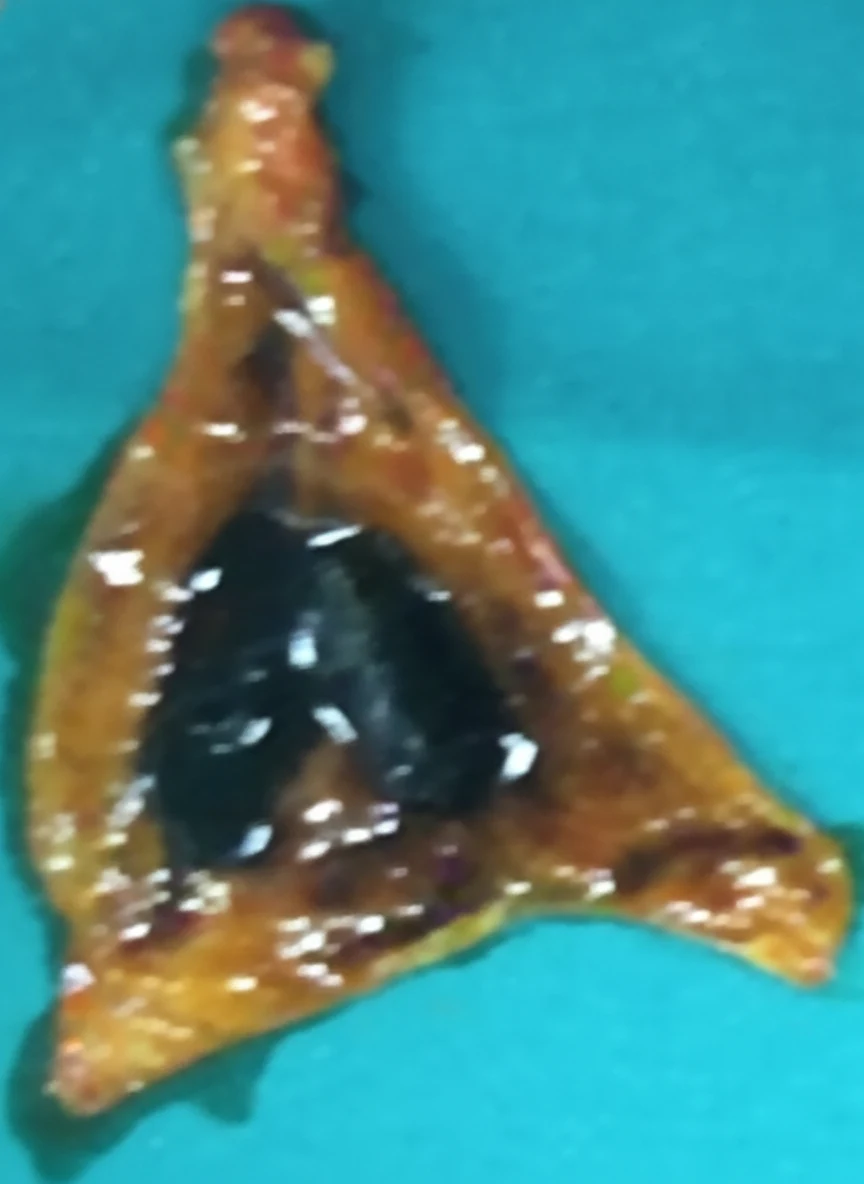 Figure 2.Surgical specimens of spleen and gallbladder.(Courtesy Dr.V.Penopoulos). 2