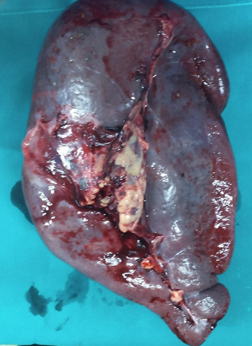 Figure 2.Surgical specimens of spleen and gallbladder.(Courtesy Dr.V.Penopoulos). 1