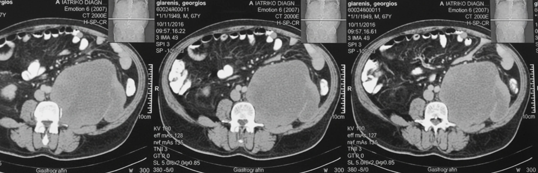 Figure 1.Abdominal CT Scan.Huge retroperitoneal "mass".(Courtesy Dr.V.Penopoulos). 1