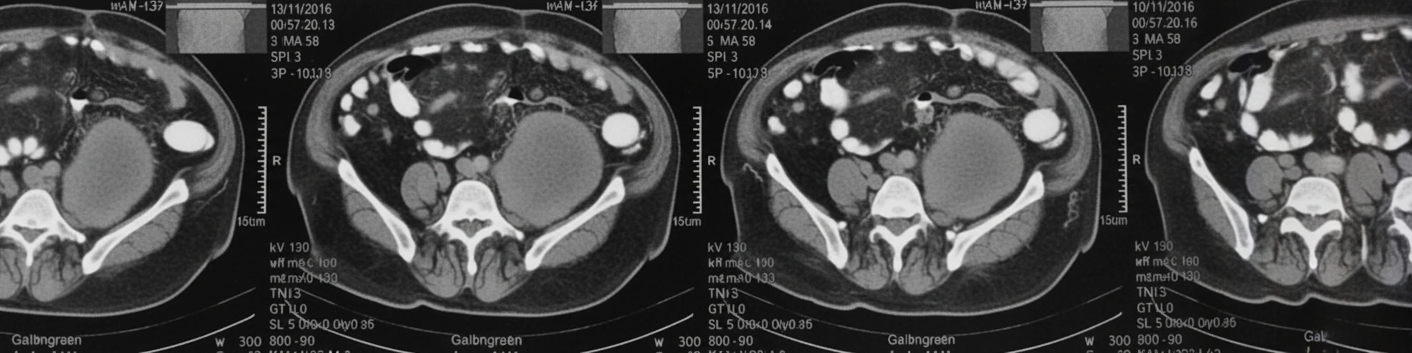 Figure 1.Abdominal CT Scan.Huge retroperitoneal "mass".(Courtesy Dr.V.Penopoulos). 3