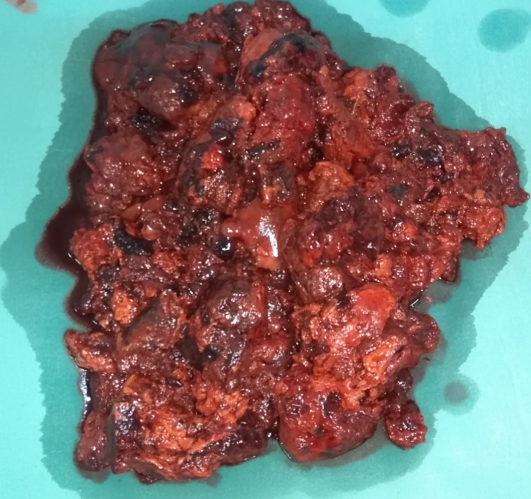 Figure 2.Cross-sectioned angiosarcoma.(Courtesy Dr.V.Penopoulos).