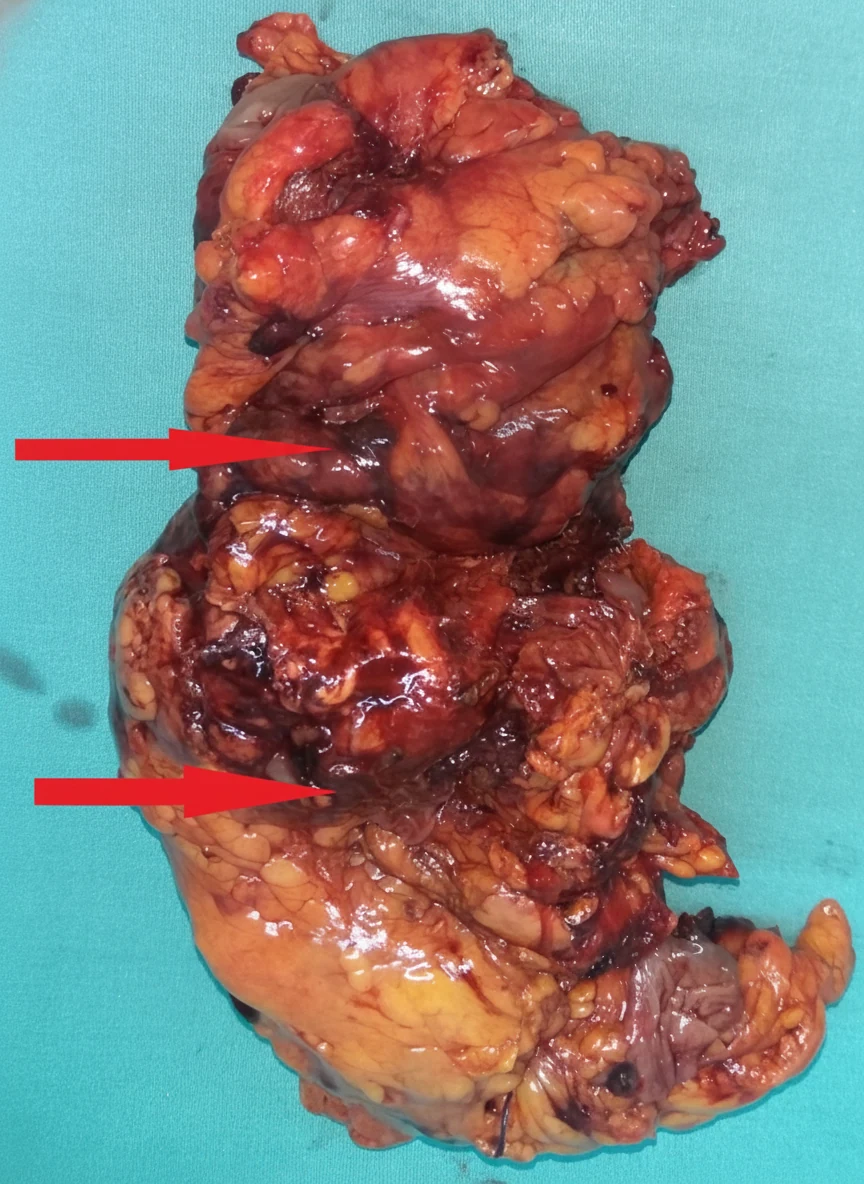 Figure 4.Rectosigmoid specimen.Red arrows - Direct infiltration of sigmoid colon.(Courtesy Dr.V.Penopoulos).