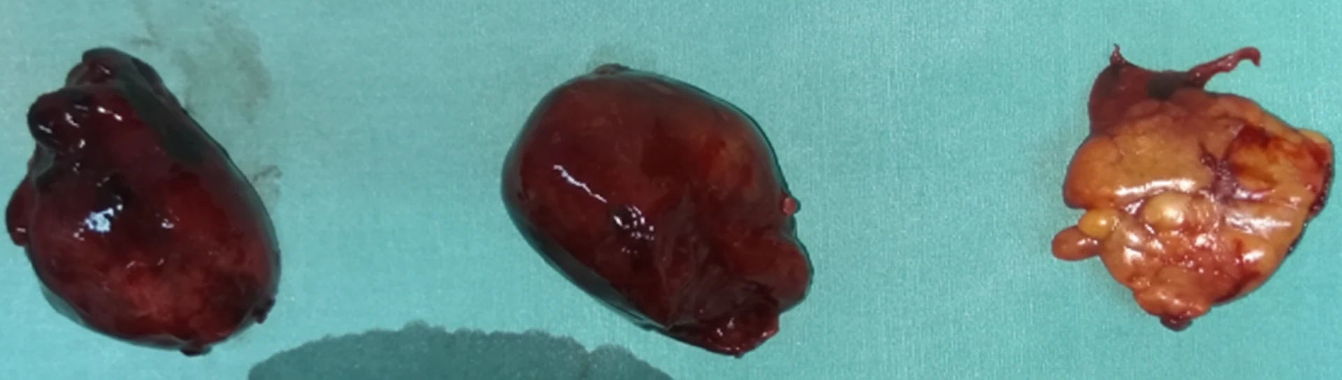 Figure 5.Angiosarcoma seeds found in presacral region.(Courtesy Dr.V.Penopoulos).