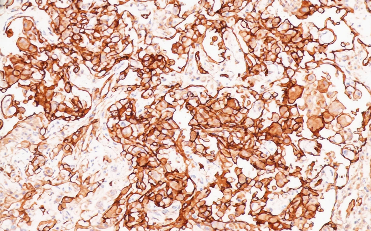 Figure 7.Immunohistochemical examination - CD31(+).Courtesy Dr.V.Penopoulos).