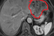 Figure 1.Abdominal MRI.Tumor of the left hepatic lobe.(Courtesy Dr.V.Penopoulos).