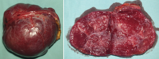 Figure 2.Surgical specimen of the excised hepatic GIST.(Courtesy Dr.V.Penopoulos).