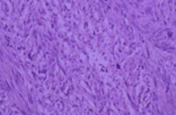 Figure 3.Spindle-shaped cells organized in fascicles, with hyperchromatic nuclei.(Courtesy Dr. V. Penopoulos).