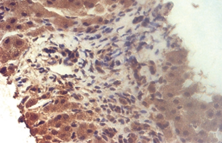 Figure 4.Diffuse and strongly positive expression for CD117.(Courtesy Dr. V. Penopoulos).