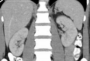 Figure 3.Abdominal CT Scan without patological findings.(Courtesy Dr.V.Penopoulos).