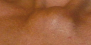 Figure 1.Nodule anterior chest wall.(Courtesy Dr.V.Penopoulos).