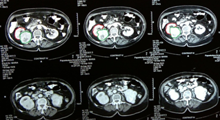 Figure 5.CT Scan.Sizable tumor right kidney.(Courtesy Dr.V.Penopoulos).