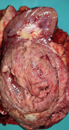 Figure 7.Surgical specimen of right nephro-ureterectomy.(Courtesy Dr.V.Penopoulos).