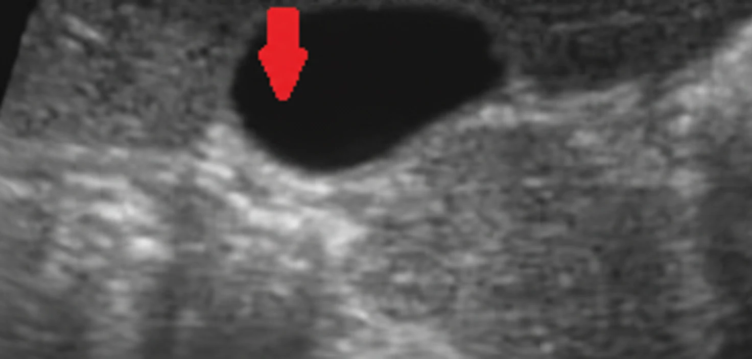 Figure 1.Gallbladder polyp.(Courtesy Dr. V. Penopoulos).