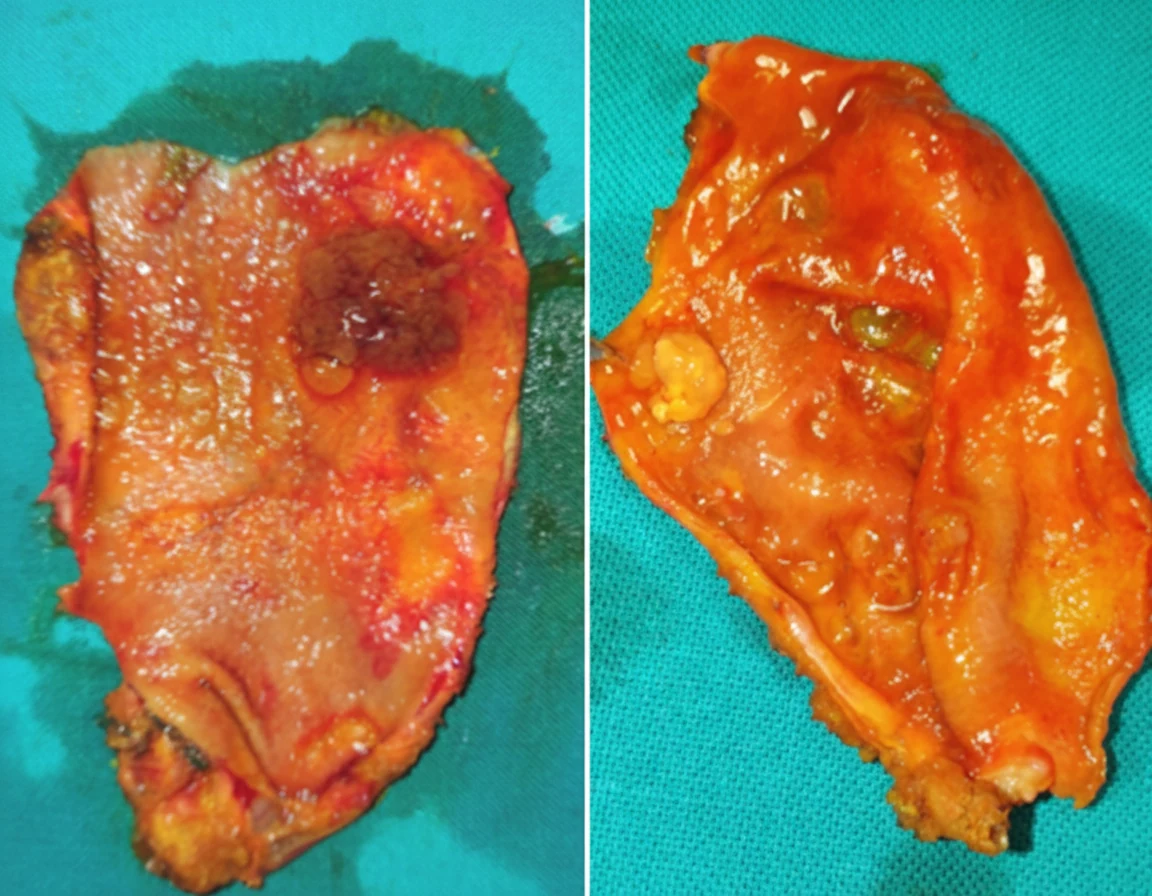 Figure 2.Surgical specimens. Gallbladder polyps.(Courtesy Dr. V. Penopoulos).