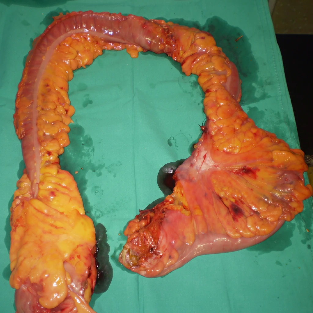 Adult Type Hirschprung's Disease.
