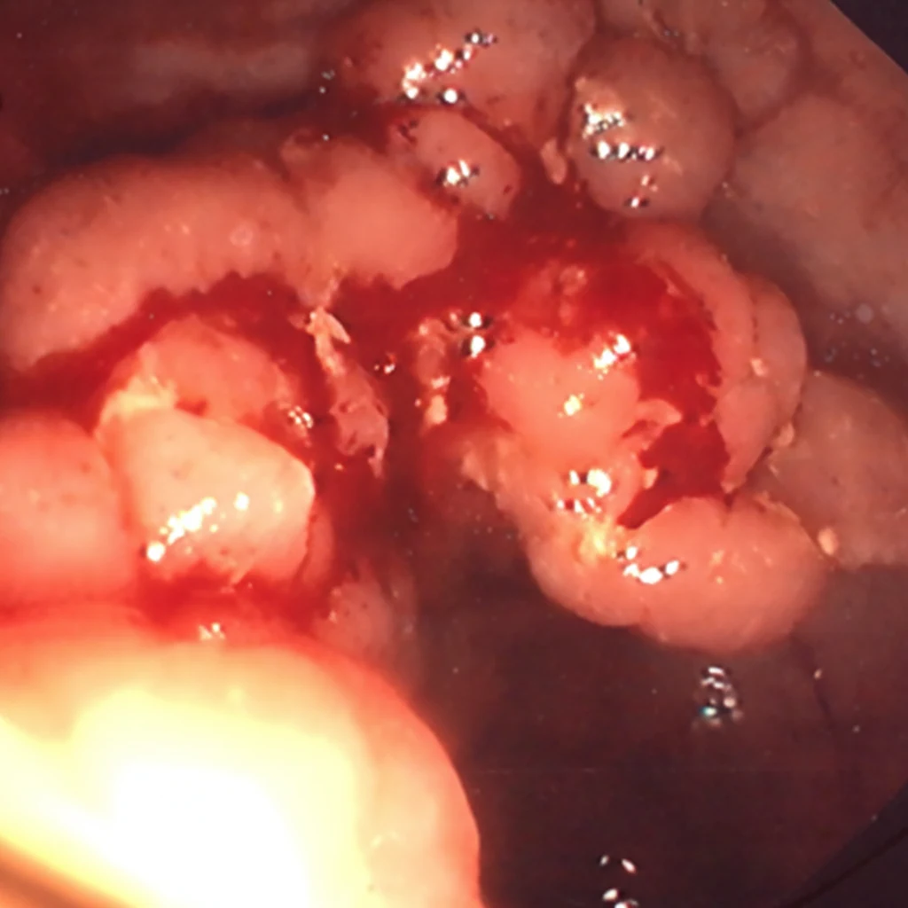 Figure 2.Colonoscopy.Cecal "cauliflower-like" mass.(Courtesy Dr.V.Penopoulos).
