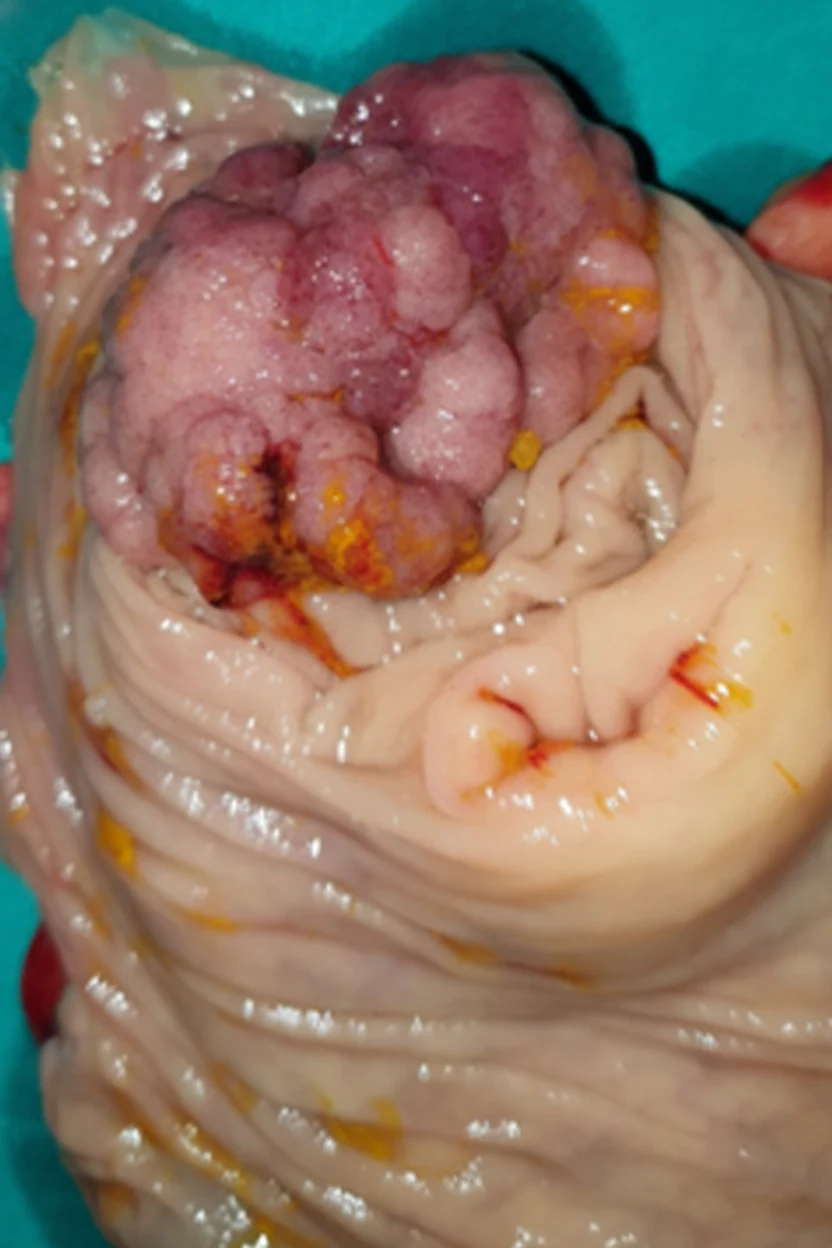 Figure 4.Right hemicolectomy specimen.(Courtesy Dr.V.Penopoulos).