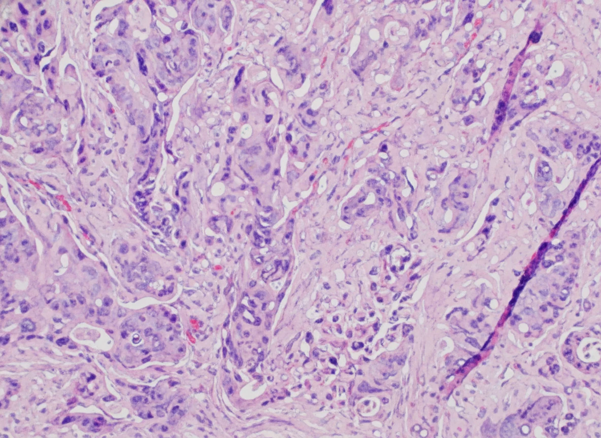 Figure 5.Histopathology.Moderately differentiated adenocarcinoma.(Courtesy Dr.V.Penopoulos).