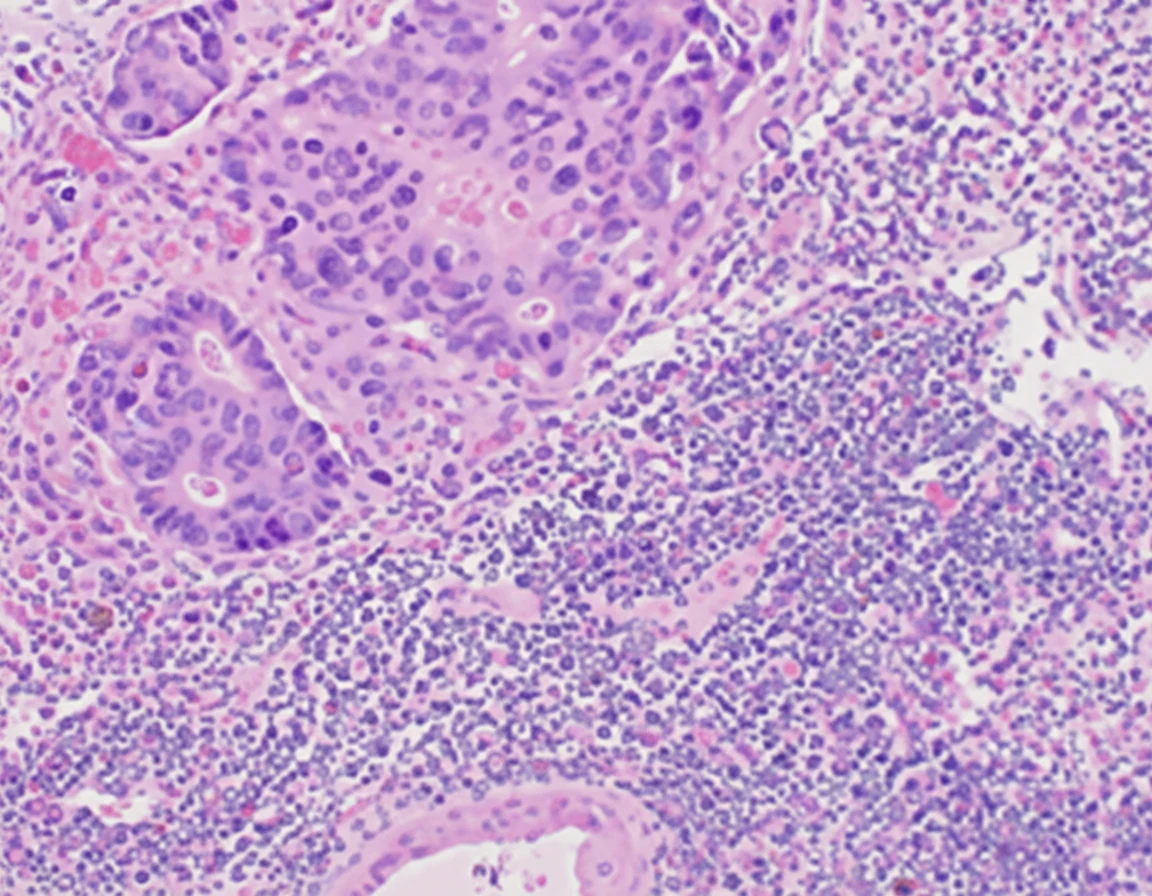 Figure 7.Infiltration of regional lymph nodes.(Courtesy Dr.V.Penopoulos).