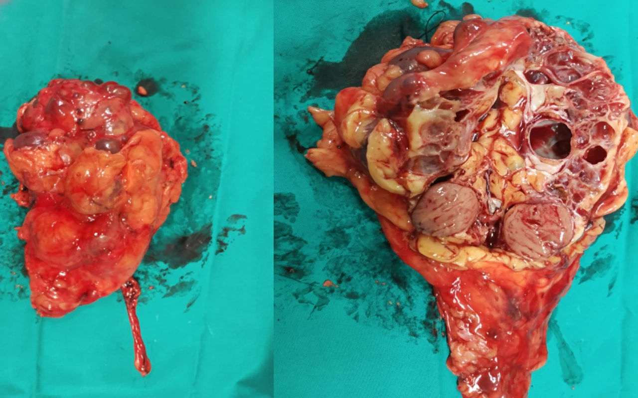 Acquired Cystic Kidney Disease-associated Renal Cell Carcinoma.