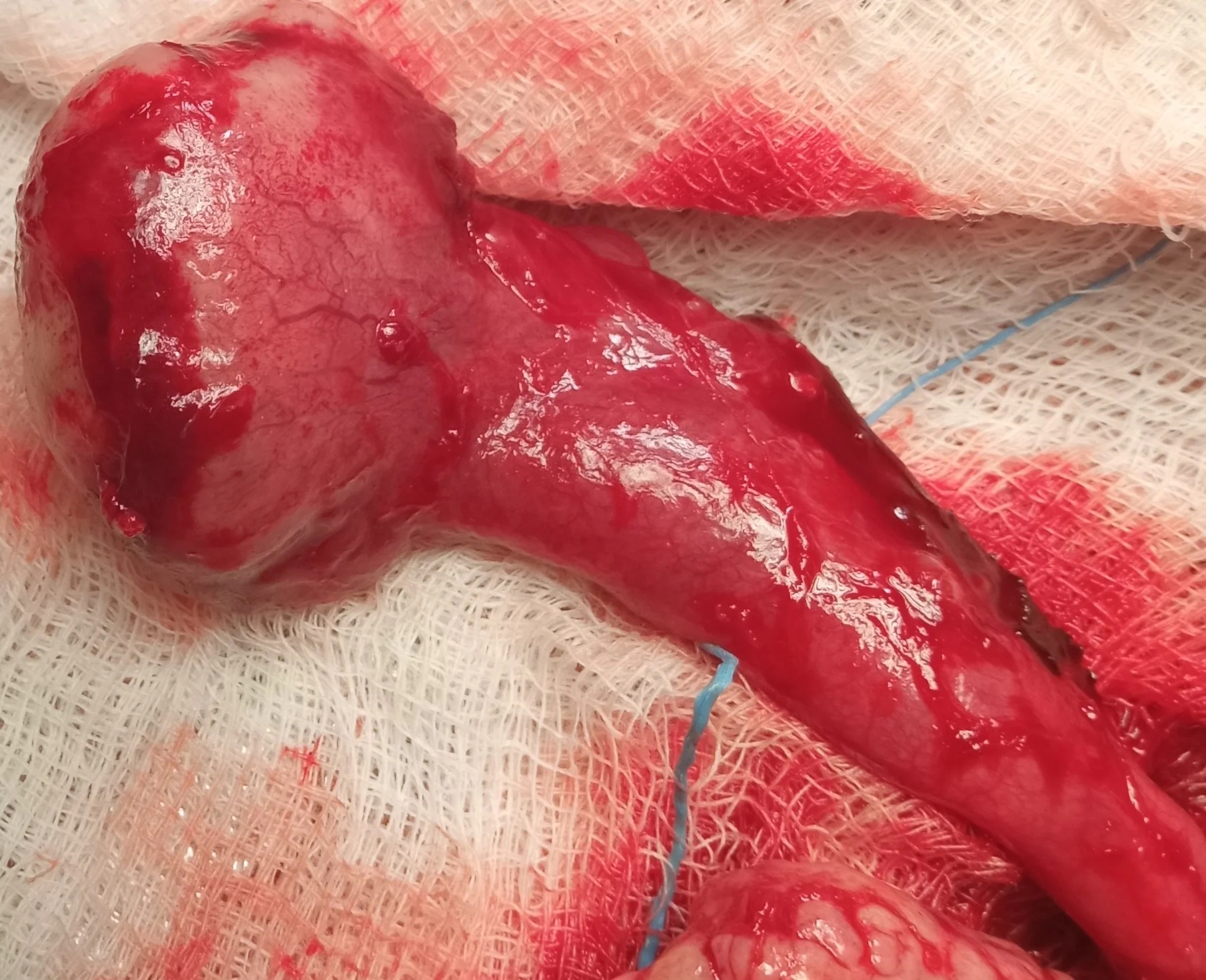 Primary Leiomyosarcoma of the Fallopian Tube.