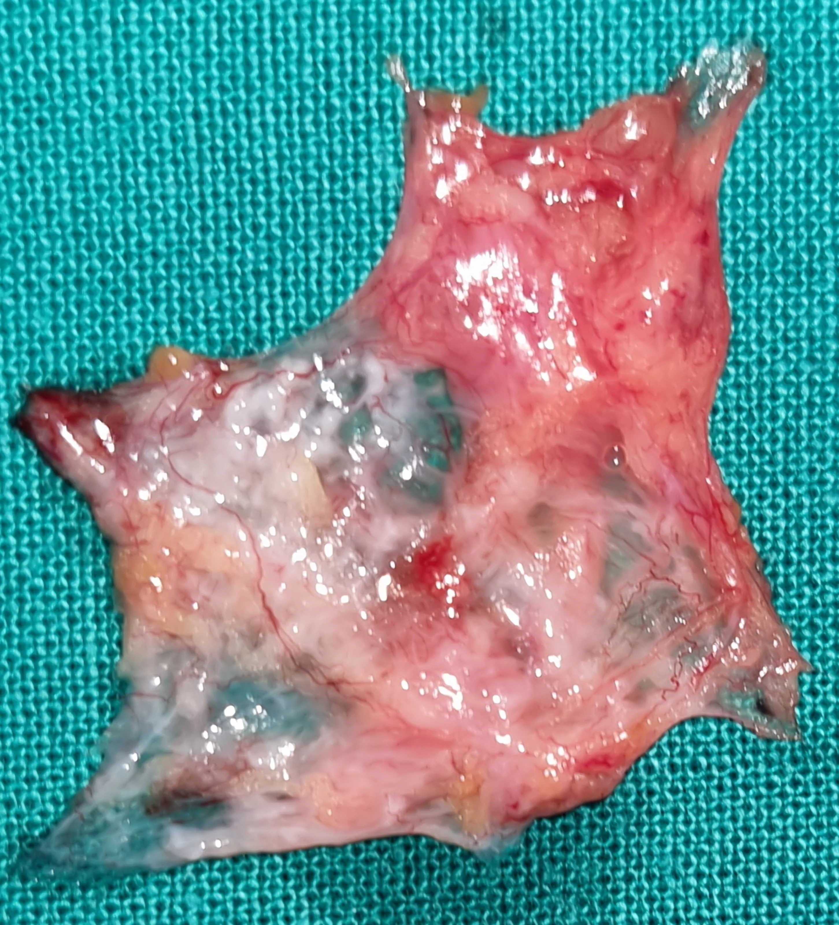 Adult Cystic Lymphangioma of the Left Supraclavicular Region.