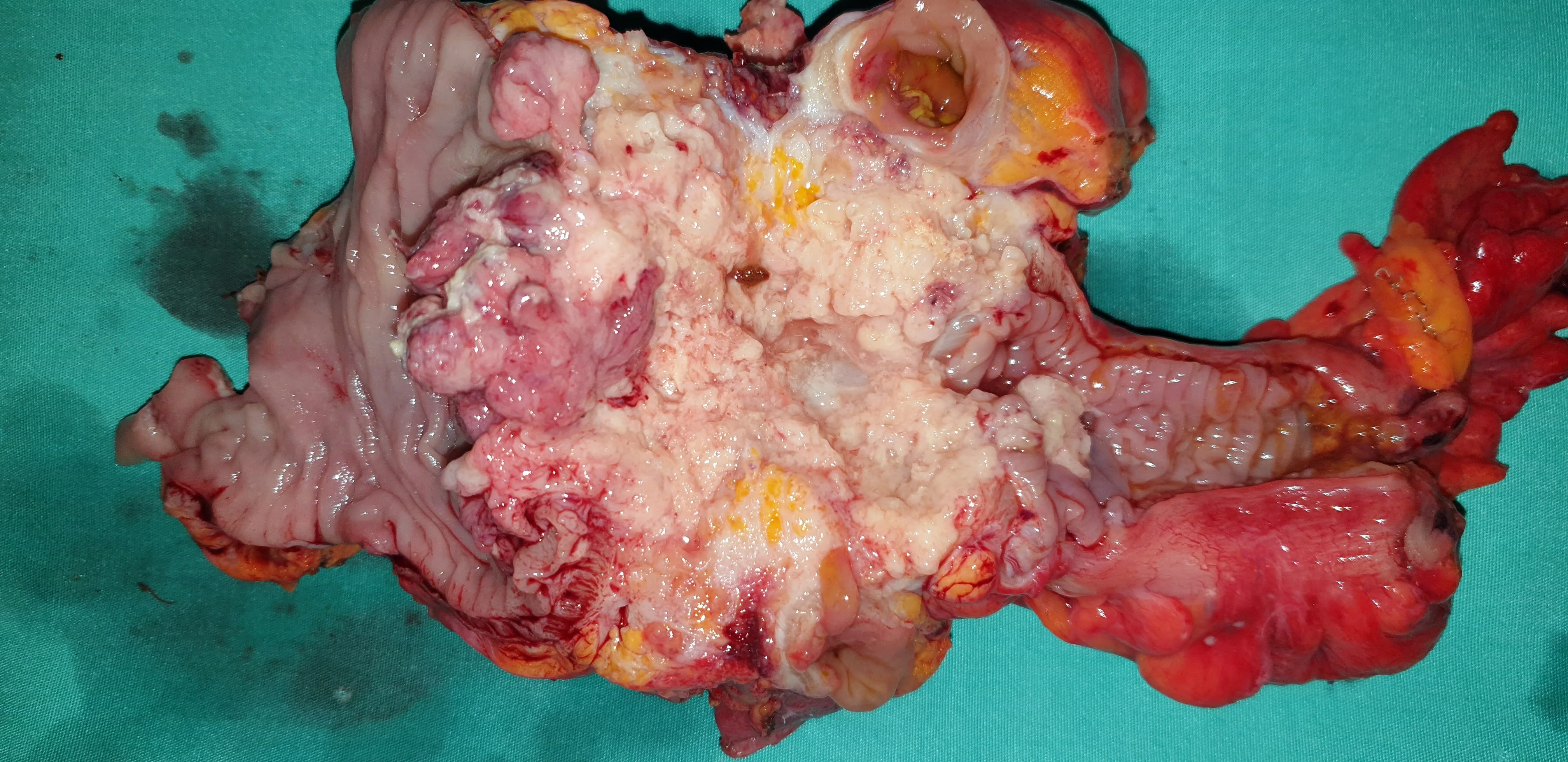Caecal Inflammatory Pseudotumor.