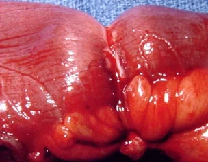 Synchronous Mucocele of the Appendix and Carcinoid of the Terminal Ileum