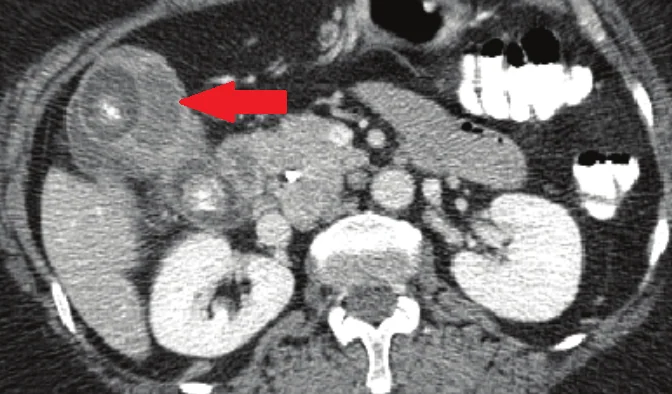 Incidental Diagnosis of Gallbladder Carcinoma in an Asymptomatic Biliary Typhoid Carrier with Chronic Cholelithiasis.