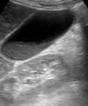 Thickened gallbladder wall and presence of biliary sludge (Courtesy Dr. V. Penopoulos)