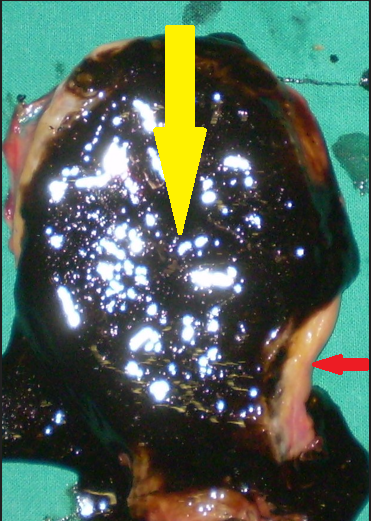Yellow arrow – Biliary sludge. Red arrow – Thickened gallbladder wall (Courtesy Dr. V. Penopoulos)