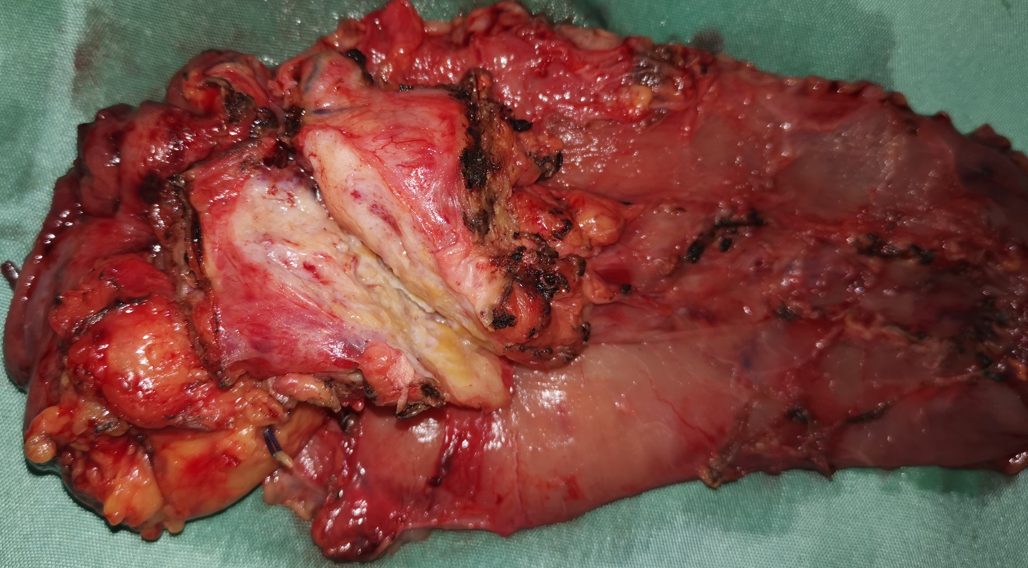 Pancreatic head carcinoma – Pancreaticoduodenectomy (Courtesy Dr. V. Penopoulos)