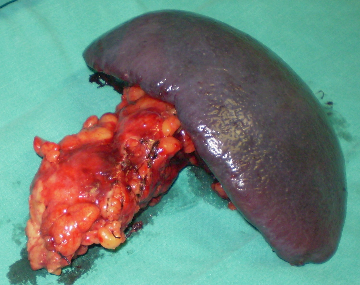 Solitary liver abscess (Courtesy Dr. V. Penopoulos)