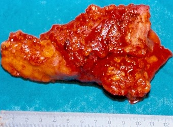 Multiple liver abscesses, 6 months and 1 year following pancreaticoduodenectomy (Courtesy Dr. V. Penopoulos)