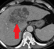Percutaneous drainage of hepatic abscess (Courtesy Dr. V. Penopoulos)