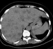 Percutaneous drainage of hepatic abscess (Courtesy Dr. V. Penopoulos)
