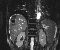 Percutaneous drainage of hepatic abscess (Courtesy Dr. V. Penopoulos)