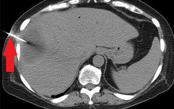Percutaneous drainage of hepatic abscess (Courtesy Dr. V. Penopoulos)