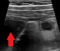 Laparoscopic view of inflamed subhepatic appendix (Courtesy Dr. V. Penopoulos)
