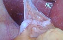Laparoscopic view of inflamed subhepatic appendix (Courtesy Dr. V. Penopoulos)