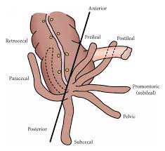 Laparoscopic view of inflamed subhepatic appendix (Courtesy Dr. V. Penopoulos)