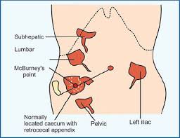 Laparoscopic view of inflamed subhepatic appendix (Courtesy Dr. V. Penopoulos)