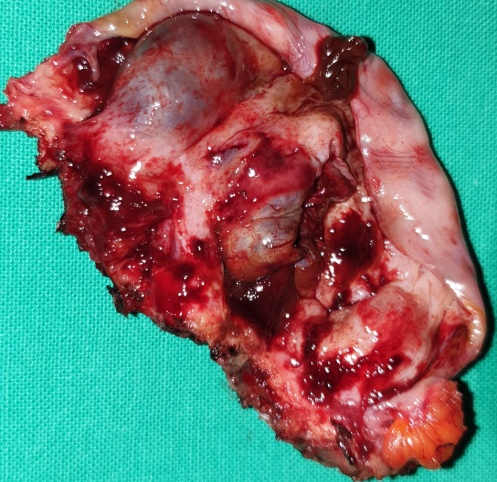 Ινομυώματα μήτρας (Ευγενική παραχώρηση Dr. V. Penopoulos)