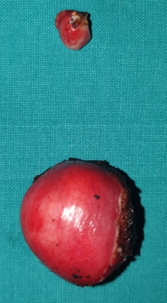 Ιστολογική εικόνα νεοπλάσματος Brenner (Ευγενική παραχώρηση Dr. V. Penopoulos)